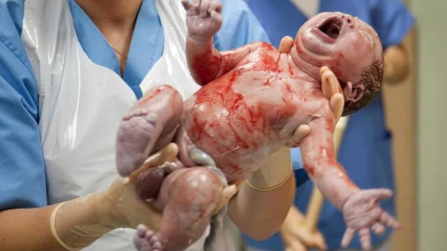 Rechtsprechung in den USA: Gericht legalisiert die gezielte Tötung von Neugeborenen