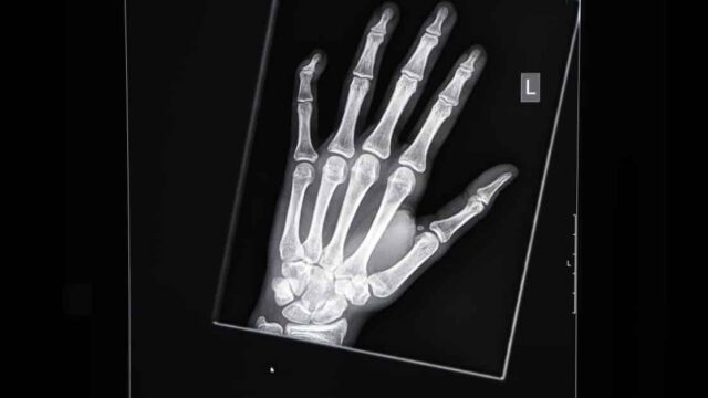 Röntgenuntersuchungen bei minderjährigen Migranten: Jeder zweite "Flüchtling" lügt beim Alter