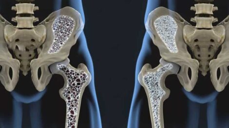 Volkskrankheit Osteoporose – was Knochen wieder stark macht!