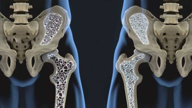 Volkskrankheit Osteoporose – was Knochen wieder stark macht!