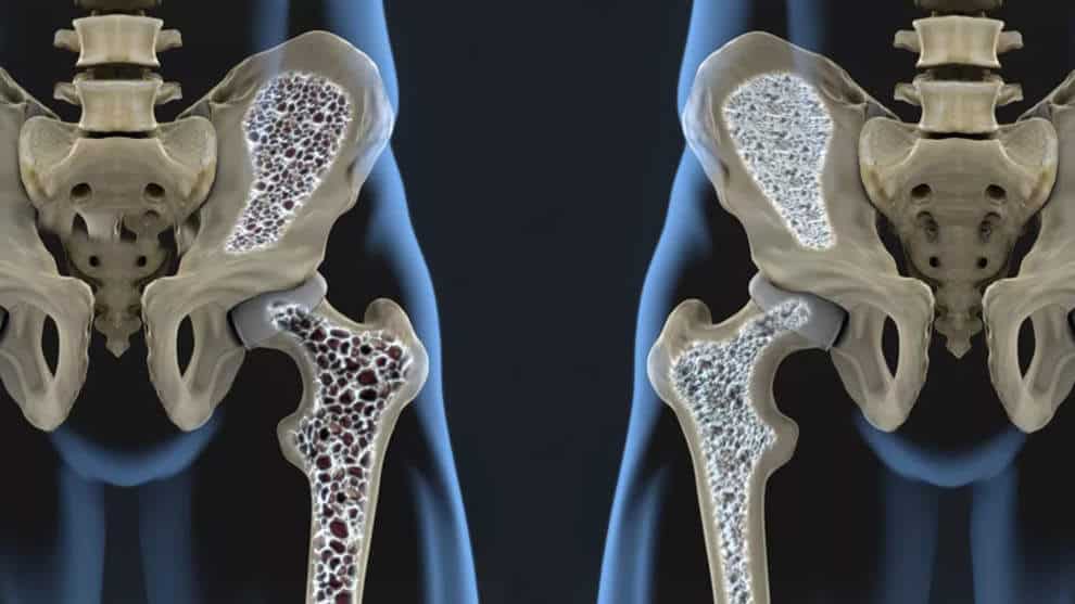 Volkskrankheit Osteoporose – was unsere Knochen wieder stärker macht!