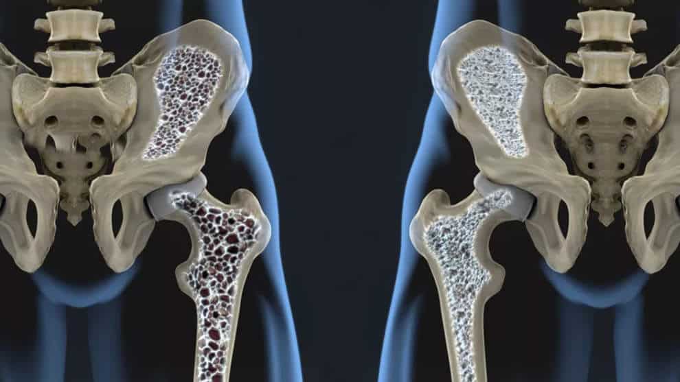 Volkskrankheit Osteoporose – was Knochen wieder stark macht!